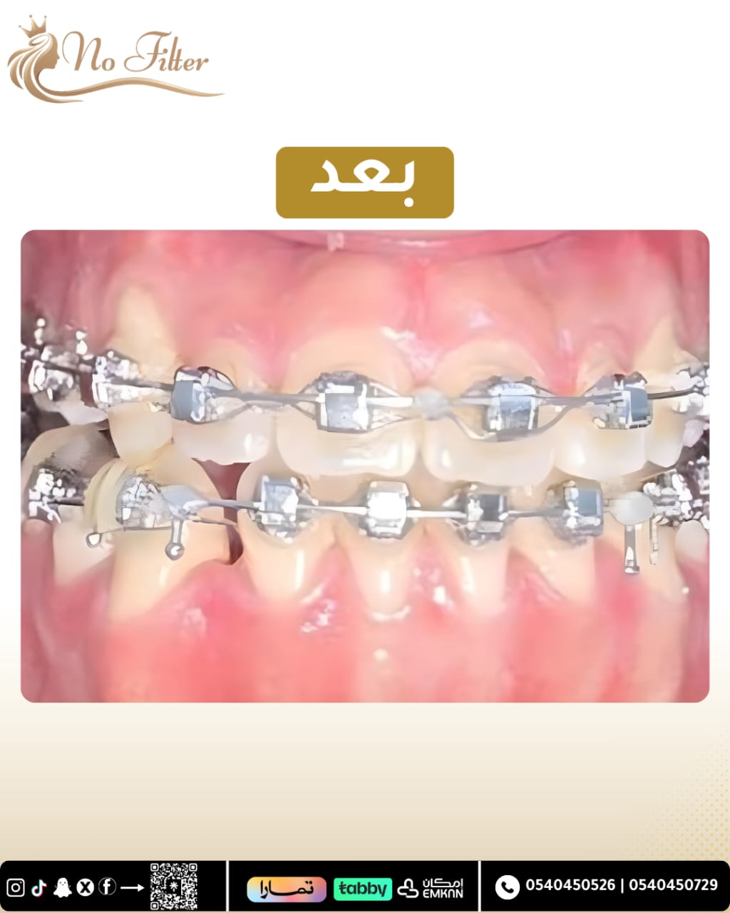 تقويم الاسنان