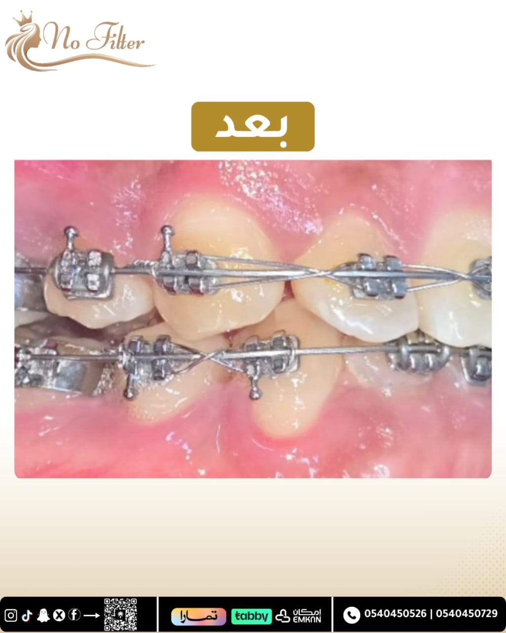 تقويم الاسنان