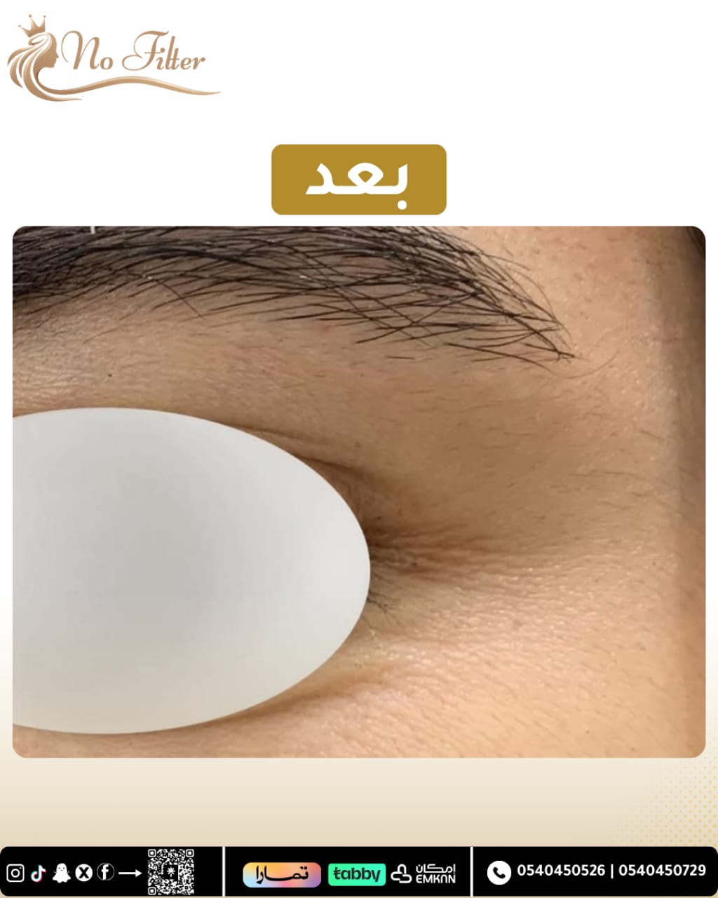 بوتوكس حول العين