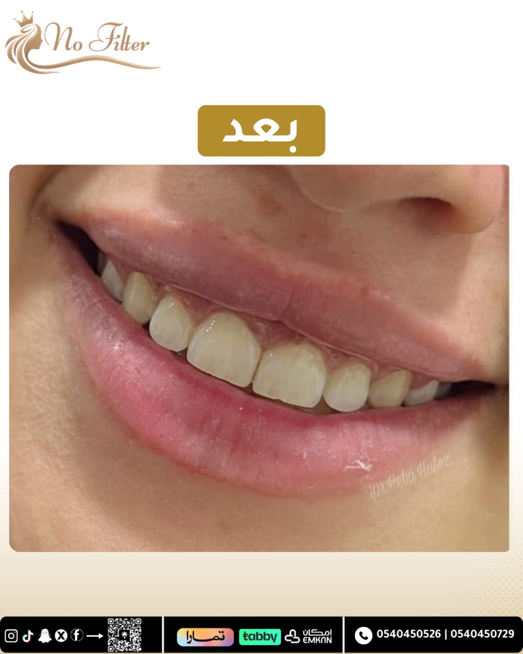 بوتوكس ابتسامة لثوية