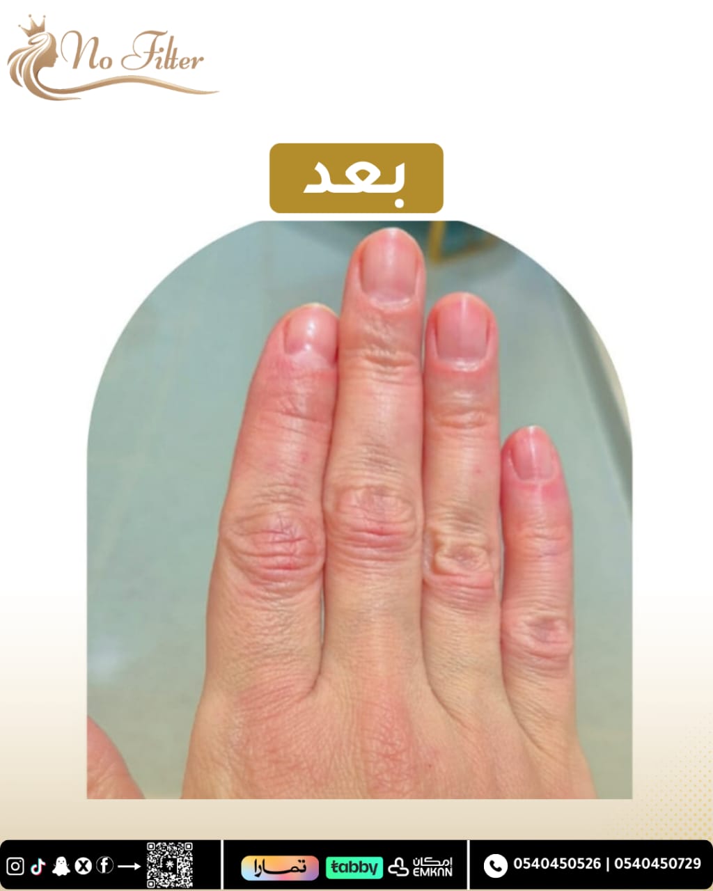 نضارة و امتلاء اليدين